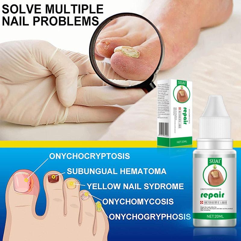 Gel anti-infeccioso Suai prego para fungos na unha